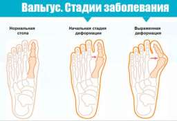 Вальгусная деформация стопы. Почему происходит