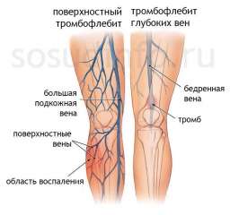 Симптомы тромба, которые вы не должны игнорировать