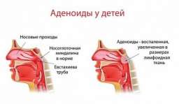 Простые советы как избавиться от аденоидов