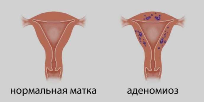 Что нужно знать женщинам об аденомиозе матки