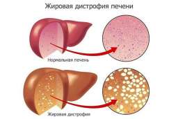 Натуральные настои при ожирении печени