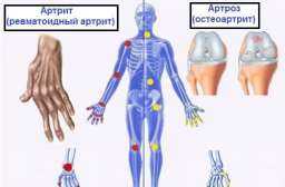 Разница между артрозом, артритом и остеопорозом. Это нужно знать