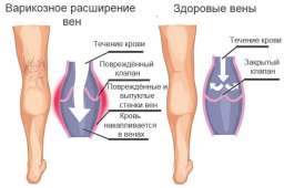 Советы Аюрведы. Варикозное расширение вен