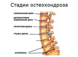 Действенные методы лечения шейного остеохондроза у женщин