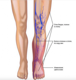 Как распознать и остановить болезнь на ранней стадии. Варикоз